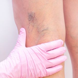 Întărirea și tonifierea pereților venoși